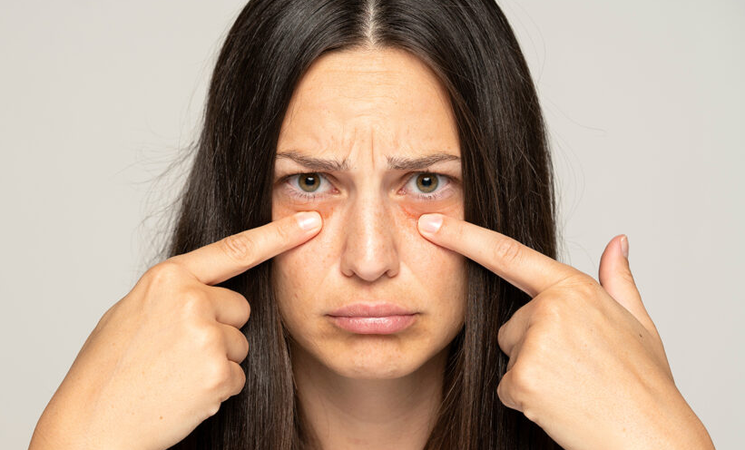 Why Do We Wake Up with Puffy Eyes?